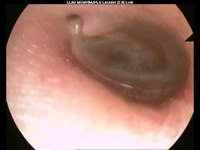 Kulakta Sıvı Toplanması Nedir?