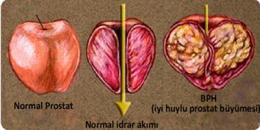 Prostat Sıvısı